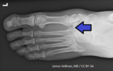 Lesione di Lisfranc