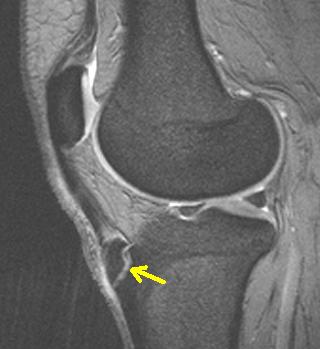 Morbo di Osgood-Schlatter