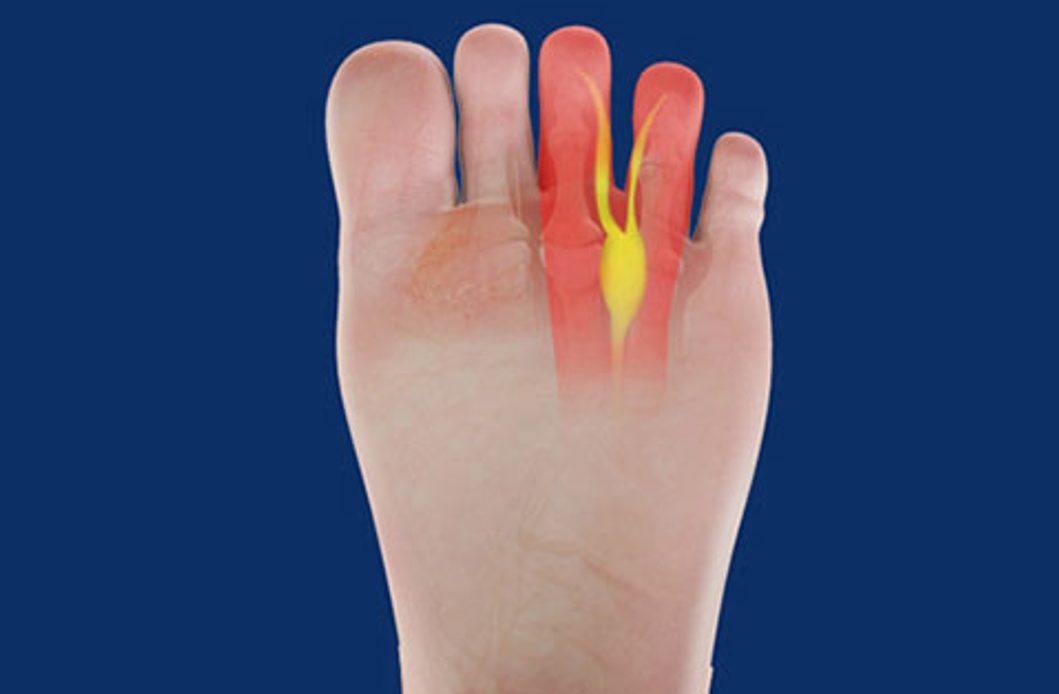 Neuroma di Morton