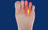 Neuroma di Morton