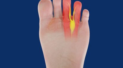 Neuroma di Morton