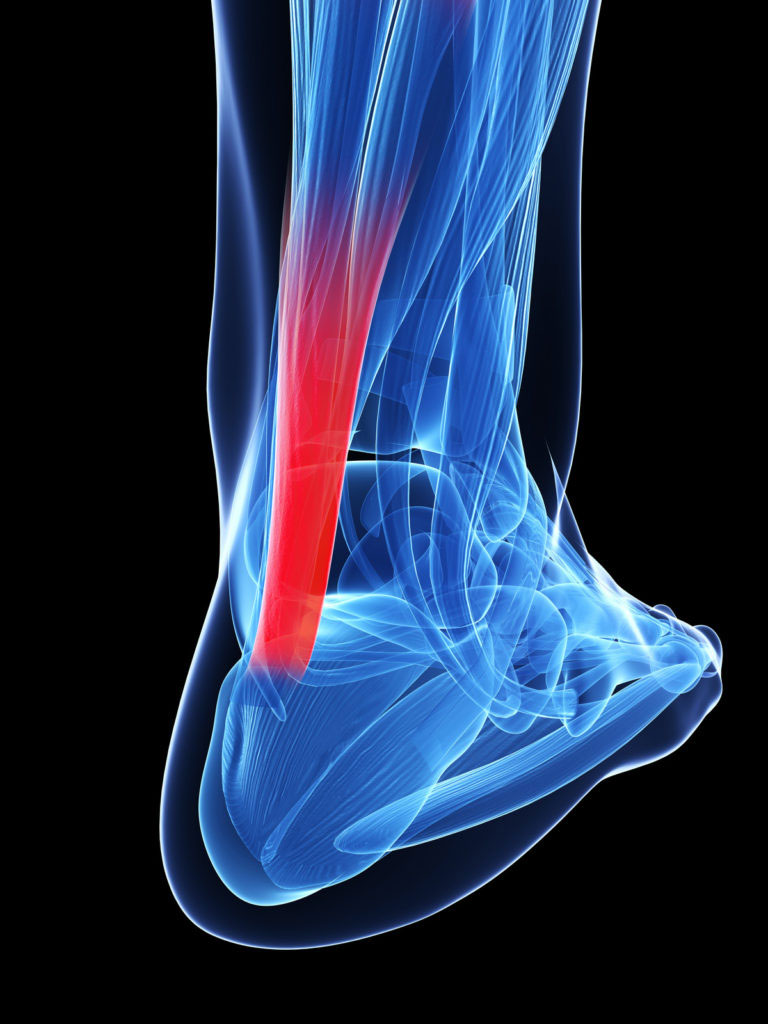 Achilles Tendinopathy