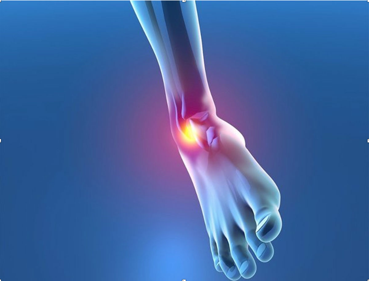 Recurrent ankle sprain – Ankle Instability