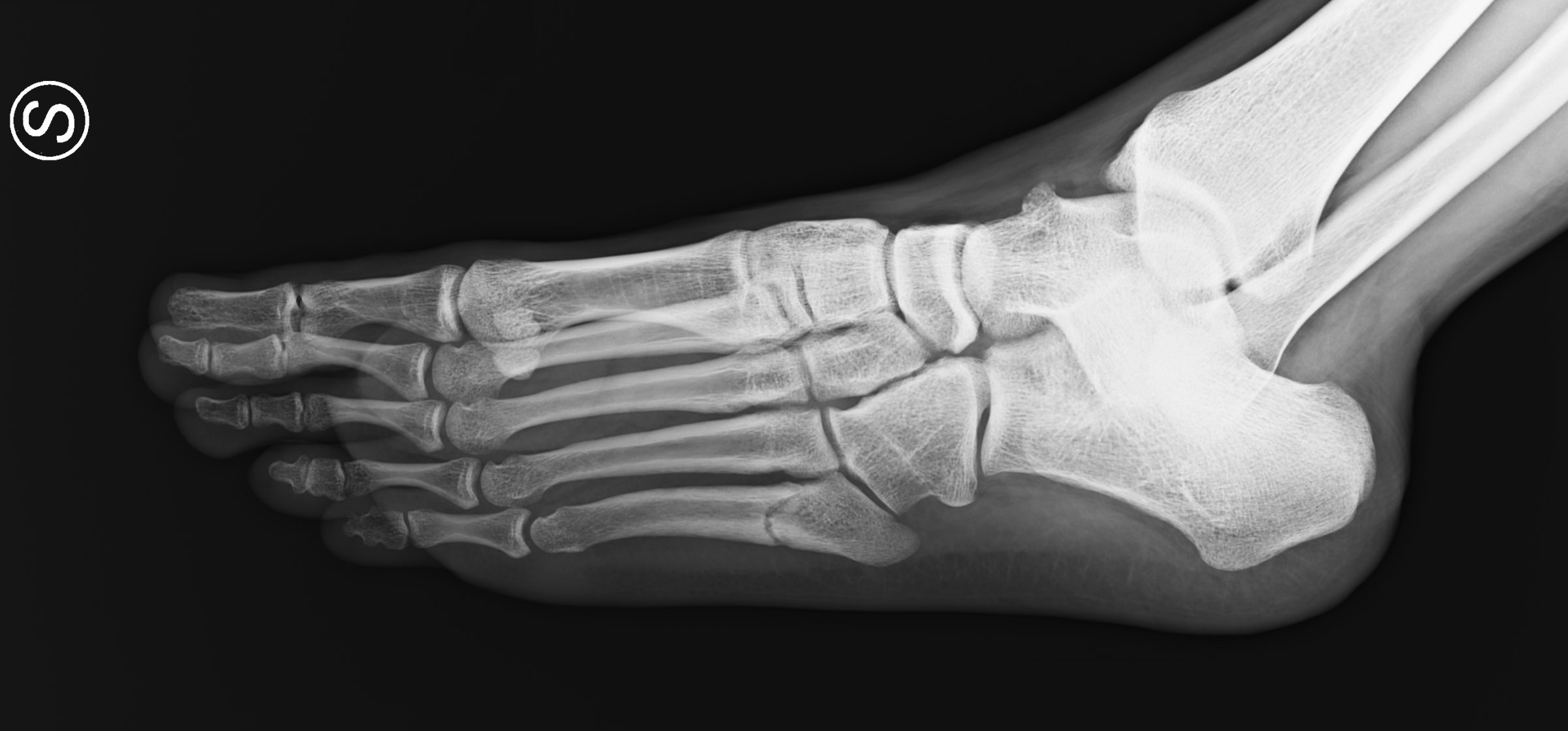 Jones fracture and 5th Metatarsal Fractures