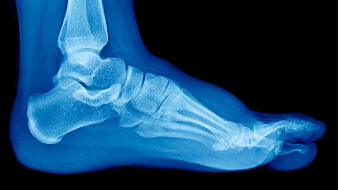 Understanding Flatfoot in Children